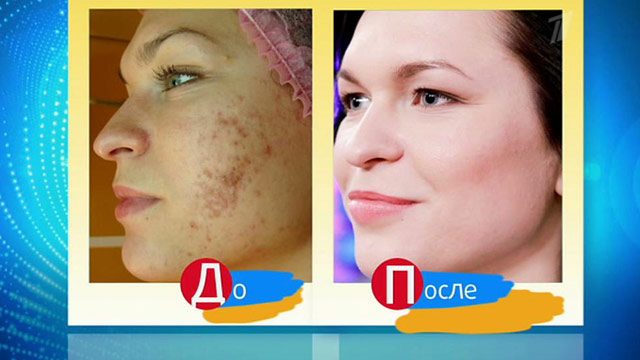 Здоровье - Хочу быть красивой. Лазерная наноперфорация - Первый канал