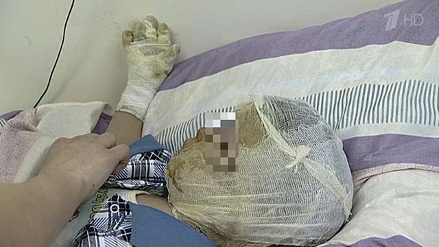 Состояние ребенка, пострадавшего из-за поджога, улучшается