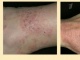 Сухость, зуд и красные пятна на кожи - признаки атопического дерматита