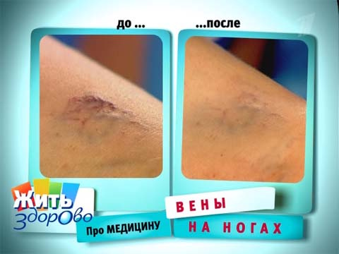 Варикоз 2 степени при беременности