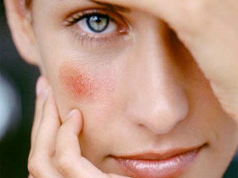 Варикоз на лице фото